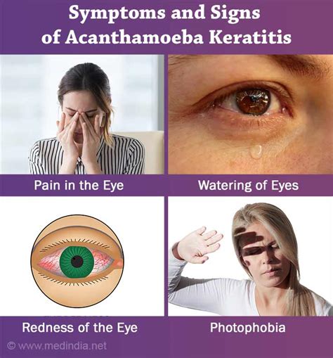 Acanthamoeba Keratitis - Symptoms, Signs, Diagnosis & Treatment