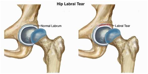 Hip Dislocation - How to Diagnose, Treat & Prevent a Serious Injury