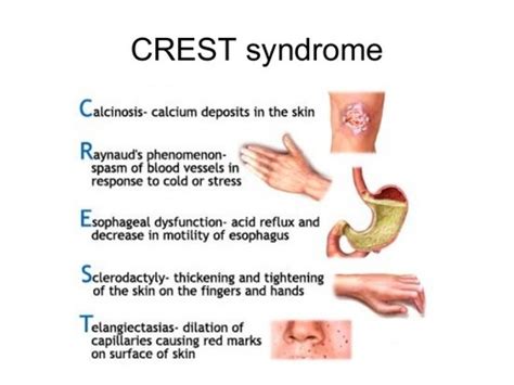 Rheumatology Flashcards | Quizlet