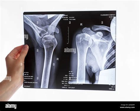 Hand holding shoulder, clavicle X-ray image. Acromion, acromial end ...