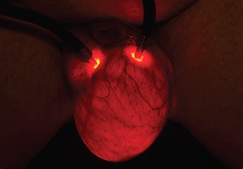 Transillumination of Testicular Hydrocele