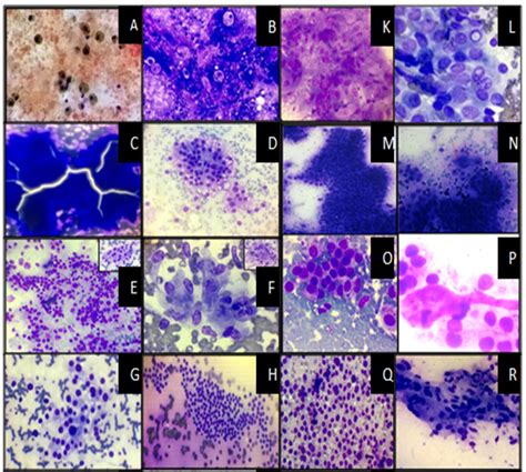 Thyroid cytology evaluation based on the Bethesda system with clinico ...