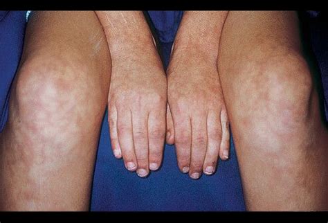 Picture of Livedo Reticularis | Livedo reticularis, Skin diseases, Skin