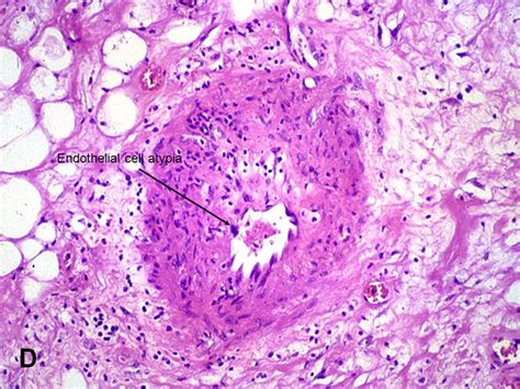 American Urological Association - Radiation Cystitis