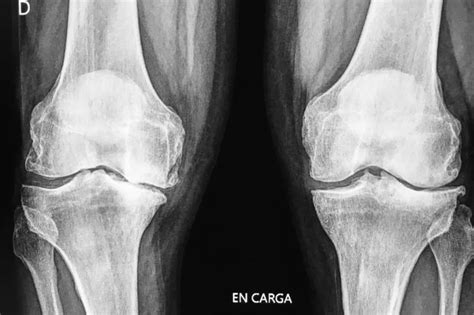 Artrosis de rodilla: nuestro enfoque terapéutico - Instituto Cugat