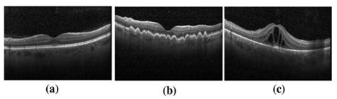 1: Retinal OCT images of a normal, b DMD and c DME conditions | Download Scientific Diagram