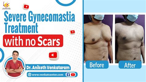 Gynecomastia Surgery