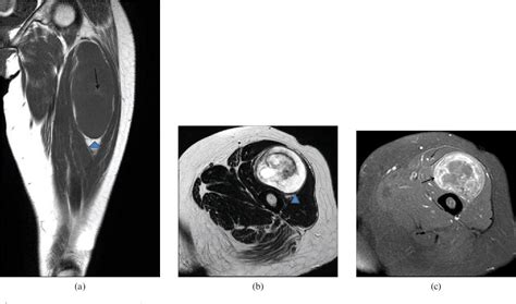 Figure 3 from Ancient schwannoma of the thigh mimicking a malignant ...