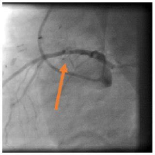 Coronary angiogram of Left Anterior Descending artery (LAD) showed ...