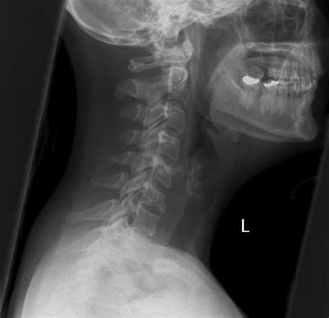 Teardrop Fracture - radRounds Radiology Network