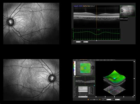 Characterizing localized retinal layer changes in AMD | Modern Retina