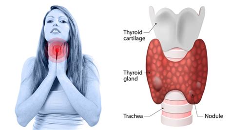 Best Thyroid Removal Surgery hospital | Thyroid Cancer Treatment Surgeons Cost in Texas USA