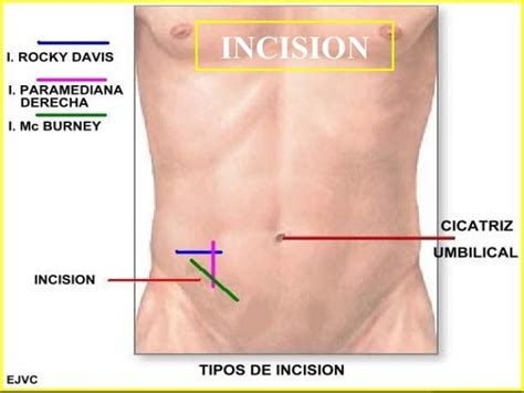 Apendicitis aguda