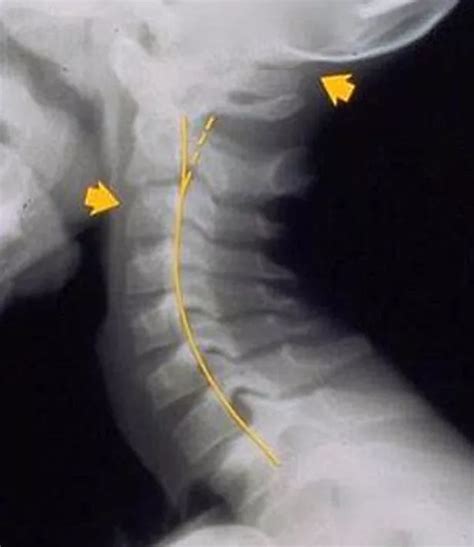 Do you have 'text neck'? Worrying X-rays show how kids are becoming hunchbacks thanks to mobile ...