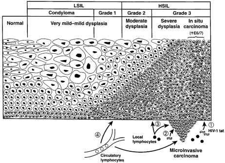 squamous intraepithelial lesions - Onco'Zine