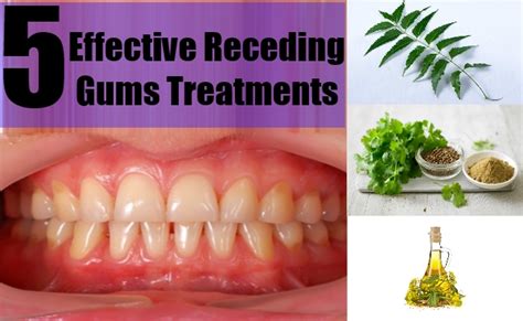 5 Effective Receding Gums Treatments - Simple And Effective Treatments For Receding Gums ...