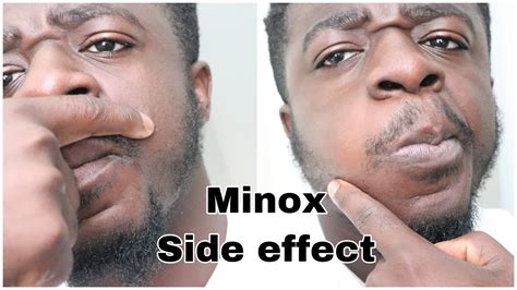 slsi.lk - how long for sulfatrim to work | Are minoxidil side effects ...