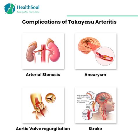 Takayasu’s Arteritis: Symptoms and Treatment – Healthsoul