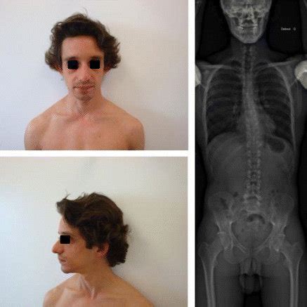 Facial dysmorphism of patient (a face and b profile) and X-Rays showing ...