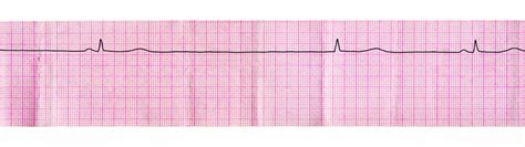 Junctional Rhythm - The Definitive Guide | Biology Dictionary