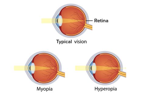 What’s the Difference Between Myopia and Hyperopia?