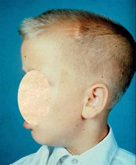 Campomelic dysplasia: MedlinePlus Genetics