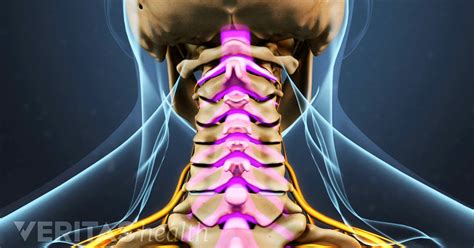 How Cervical Stenosis with Myelopathy Affects Your Body