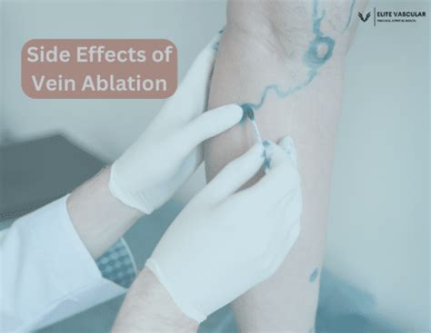 Understanding the Potential Long-Term Side Effects of Vein Ablation