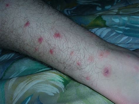 Chiggers Rash Pictures