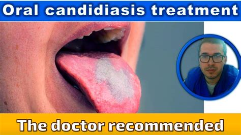 Oral candidiasis treatments - YouTube