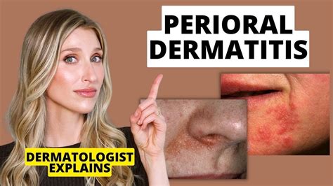 What Is Perioral Dermatitis? Symptoms, Causes, Diagnosis, Treatment, and Prevention, pregnancy ...