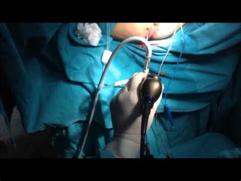 VAAFT Surgery For Fistula in Ano - YouTube