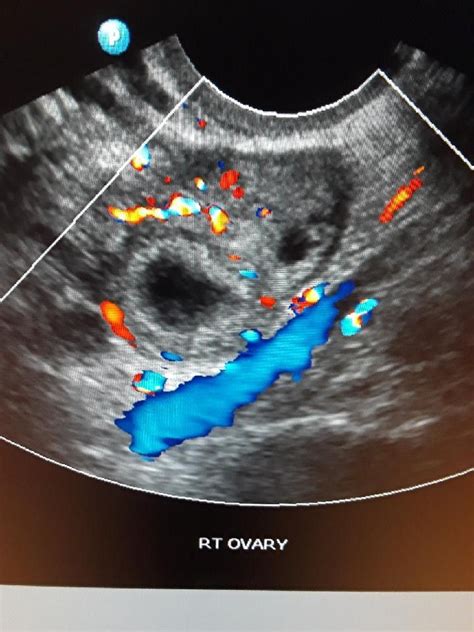 Corpus luteum cyst | Corpus luteum, Cysts, Ultrasound