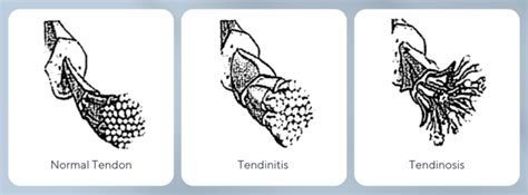 Tendinitis vs Tendinosis | Howard Chiropractic | Green Bay