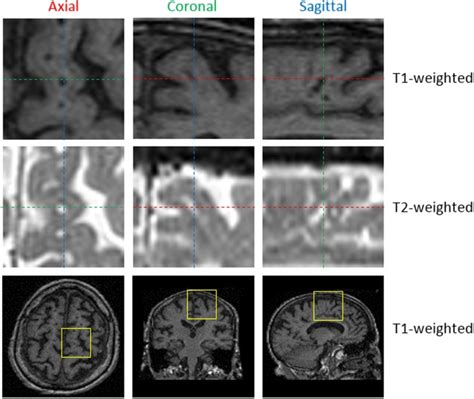 Perivascular Spaces Segmentation in Brain MRI Using Optimal 3D Filtering | Scientific Reports