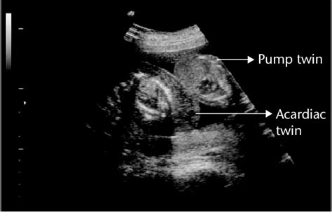 Grossly malformed acardiac twin and normal structure pump twin ...