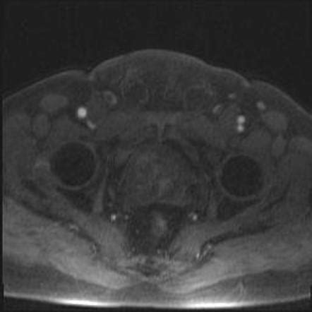 Prostate adenocarcinoma - peripheral zone PI-RADS 4 (MRI) | Image | Radiopaedia.org