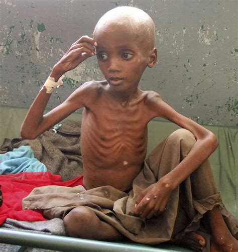 Scores of Somali children dying every day - The Portland Press Herald ...