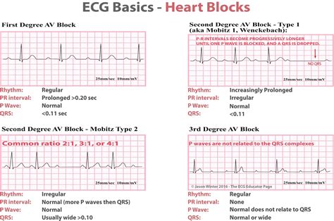 ECG Educator Blog : Heart Blocks