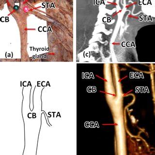 Incidence of origins of superior thyroid artery in cadaveric and... | Download Scientific Diagram