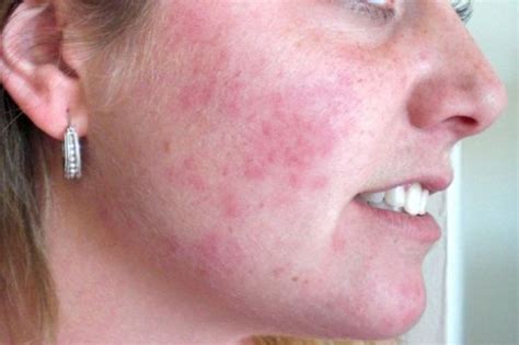 A Symptom of sensitivity | Face rash remedies, Rashes remedies, Rash on ...