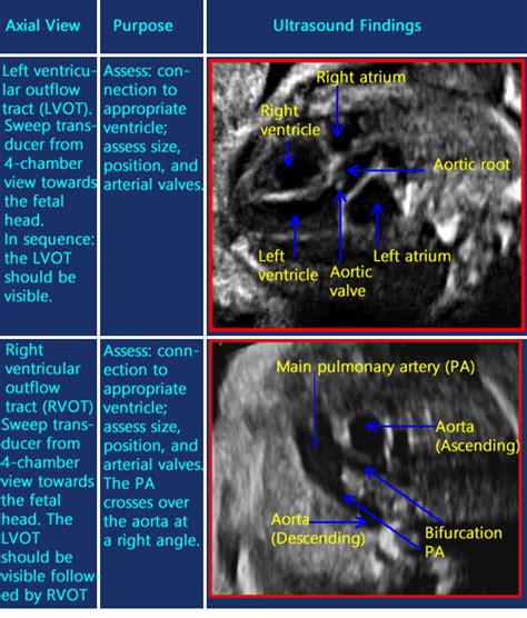 Fetal Lvot Ultrasound