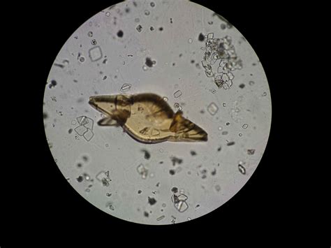 [OC] Abnormally large uric acid crystal and smaller crystals in urine under a light microscope ...