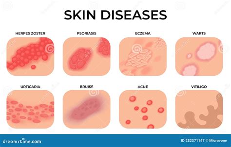 Skin Disease. Different Diseases, Epidermis Surface with Eczema ...