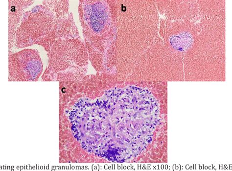 Lofgren ' s syndrome – A case report | Semantic Scholar