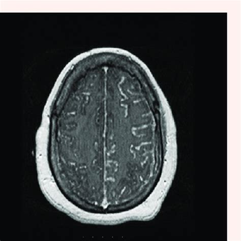 MRI of the brain, T1 weighted with gadolinium contrast showing a ...