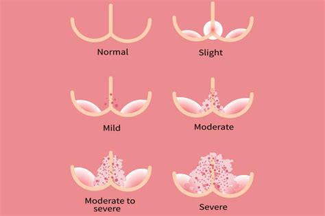 Baby's Diaper Rash: Causes, Types, Symptoms And Treatment - Baby Plumbing