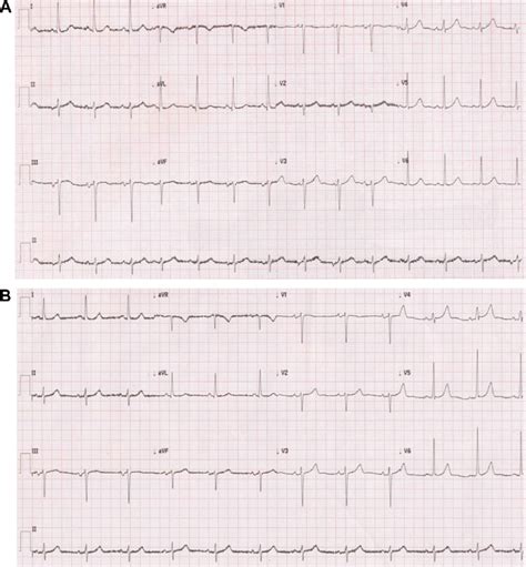 (A) Resting ECG showing the varying morphology of the P-wave, which is... | Download Scientific ...