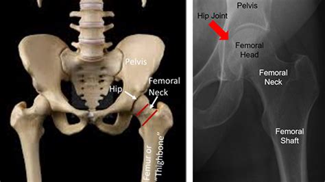 Young Patients with Femoral Neck Fracture | Orthopaedic Trauma Association (OTA)