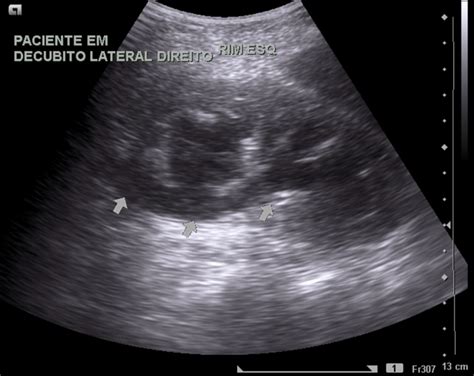 Radiopaedia case Perinephric abscess drainage id: 22397 study: 22432 ...